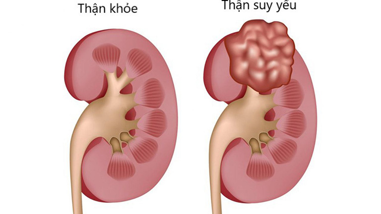 Nam giới thận yếu nên ăn những thực phẩm gì?